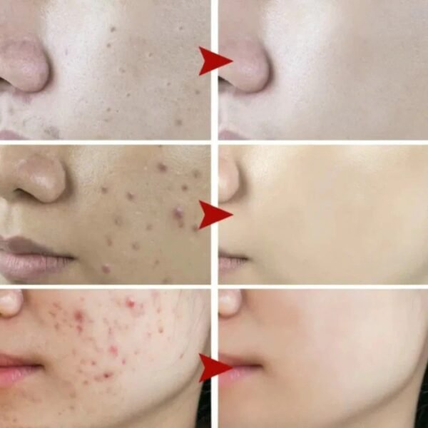 16 CeraVe Acne Foaming Cream Cleanser – 4% Benzoyl Peroxide | Deep Pore Cleanser for Oily Acne-Prone Skin