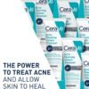 BPO4-result-desktop-700x785-v1 CeraVe Acne Foaming Cream Cleanser – Powerful 4% Benzoyl Peroxide Face Wash